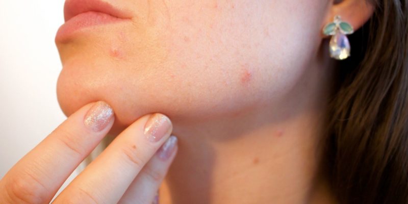 acne-femme
